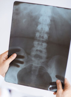 osteoartrosi