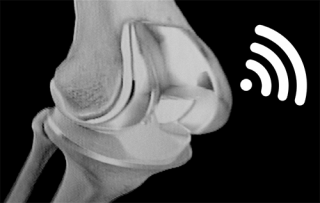 protesi di ginocchio "smart"